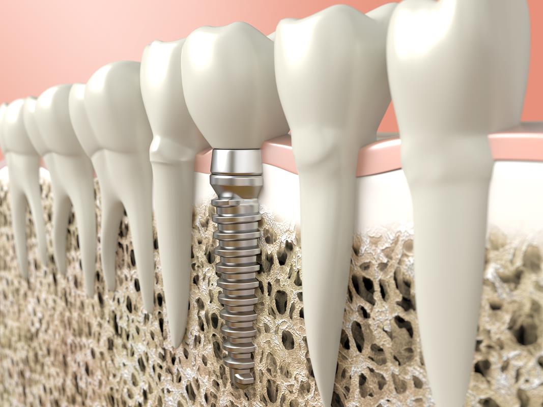 Dental Implants  Thornhill, ON LT C